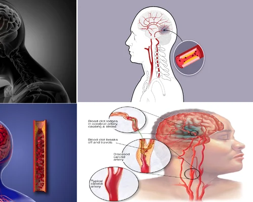 Atacul cerebral vascular reprezintă una dintre principalele cauze de deces în România Colaj DMS