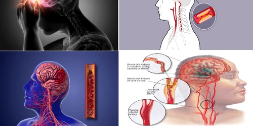 Atacul cerebral vascular reprezintă una dintre principalele cauze de deces în România Colaj DMS